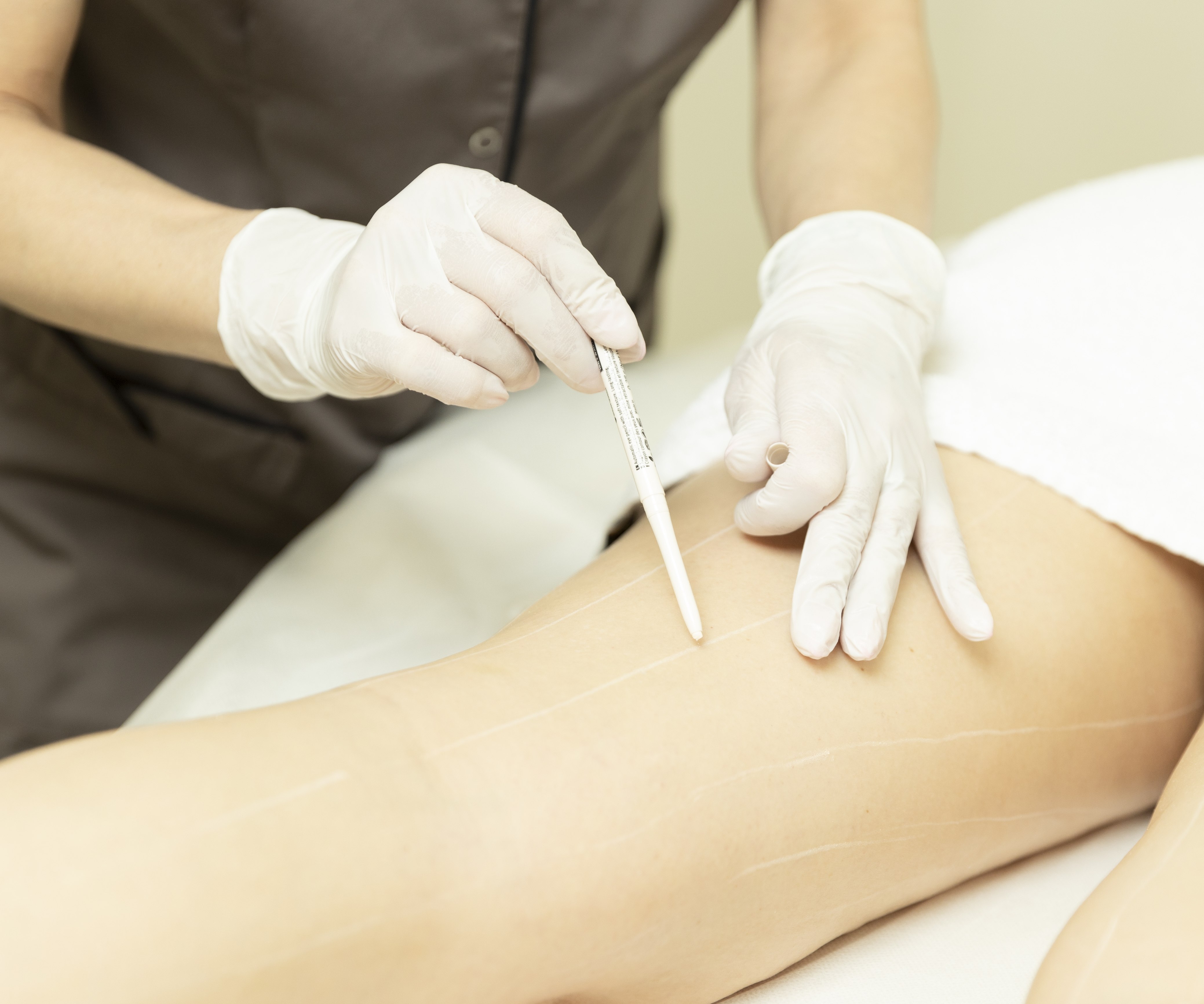 Vorteile der Superpulse methode, Haarentfernung bei einem Bein